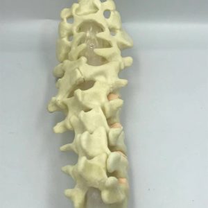 Pediatric deformed lumbar spine
